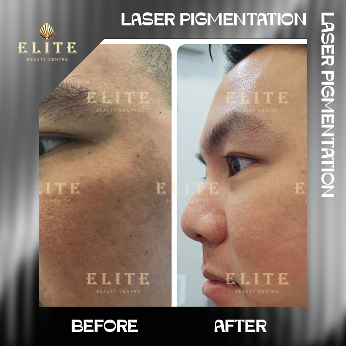 LASER PIGMENTATION